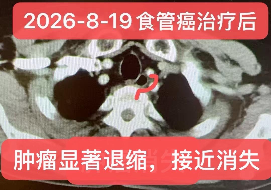个案分享：一例晚期食管癌的治疗。【个案分享】一例晚期食管鳞癌（cT4N...