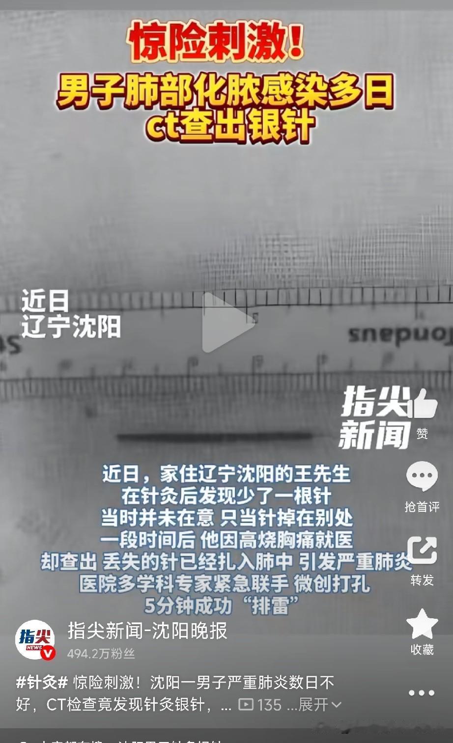 针灸大意不得

沈阳有个王先生，前阵子咳嗽咳黄痰，胸口还疼，拖了好几天吃药也不好