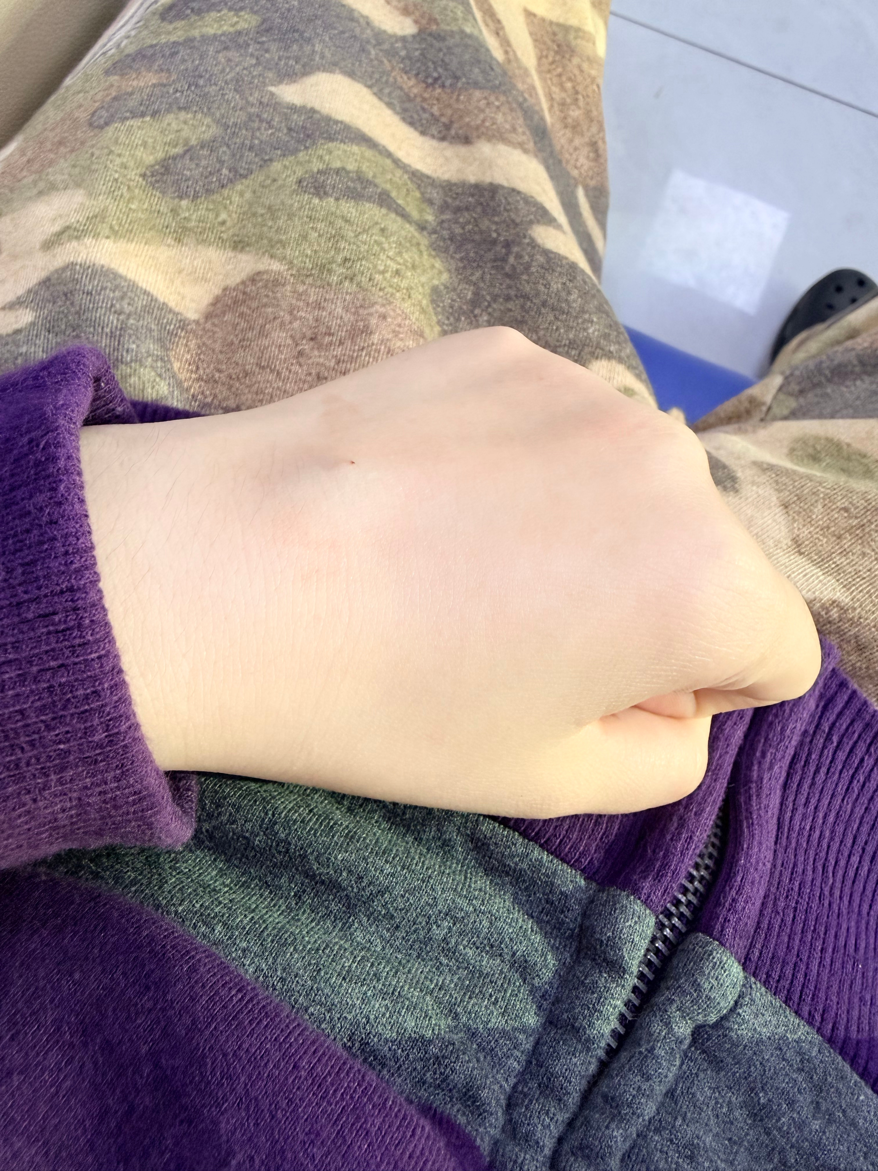 手被扎的鼓了个大包。 