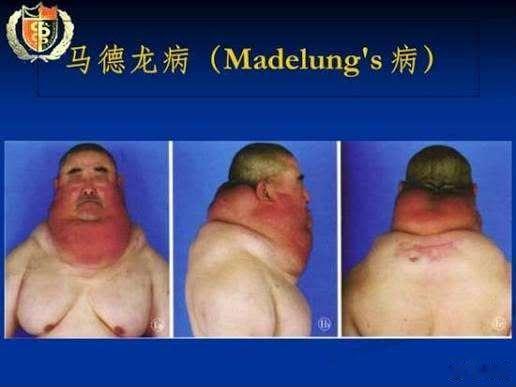真人照片，不是PS，也不是派大星转世，他得的病叫马德龙，首要诱因：长期大量酗酒，