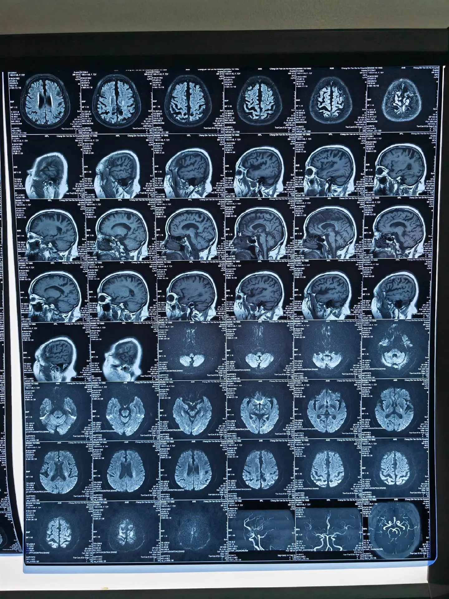 皮质基底节变性(CBD)