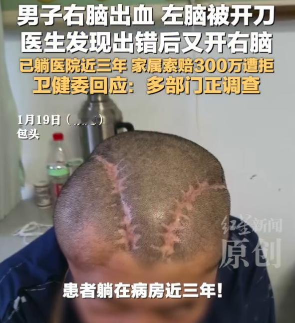 男子右脑出血被医生错开左脑 这是头啊，脑袋啊！！！这也能分不清左右了吗？要不要这