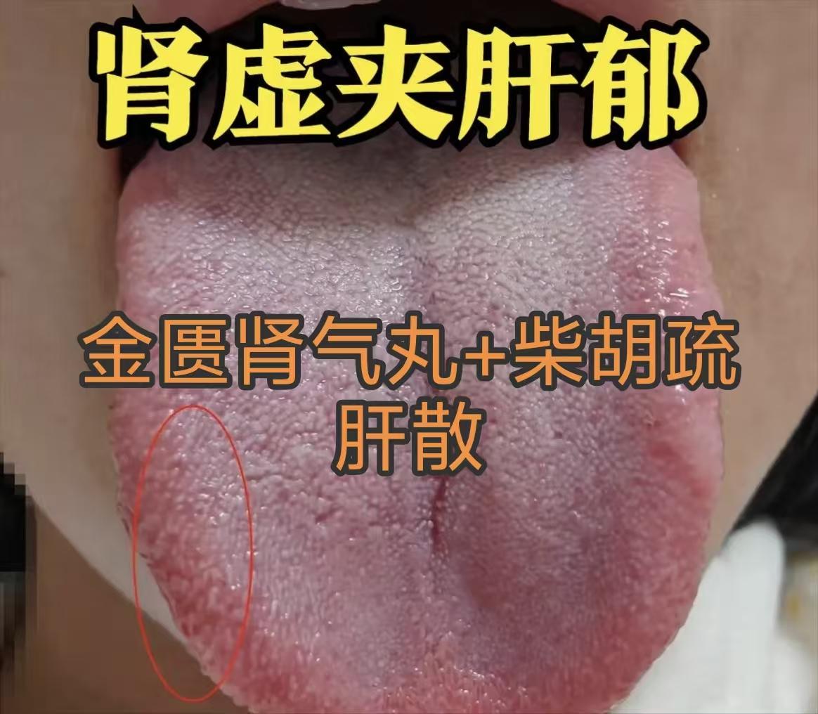 男性别再乱补肾了！先看清这3种舌象，错补反而更伤身！

第一种：肾虚兼肝郁
舌象