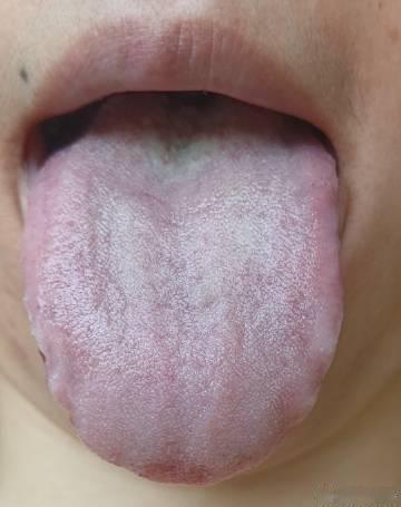 #中医式生活# 年轻女性痤疮，肚子冷，痛经。碰到这样的舌象，就不要猛起清热了，用