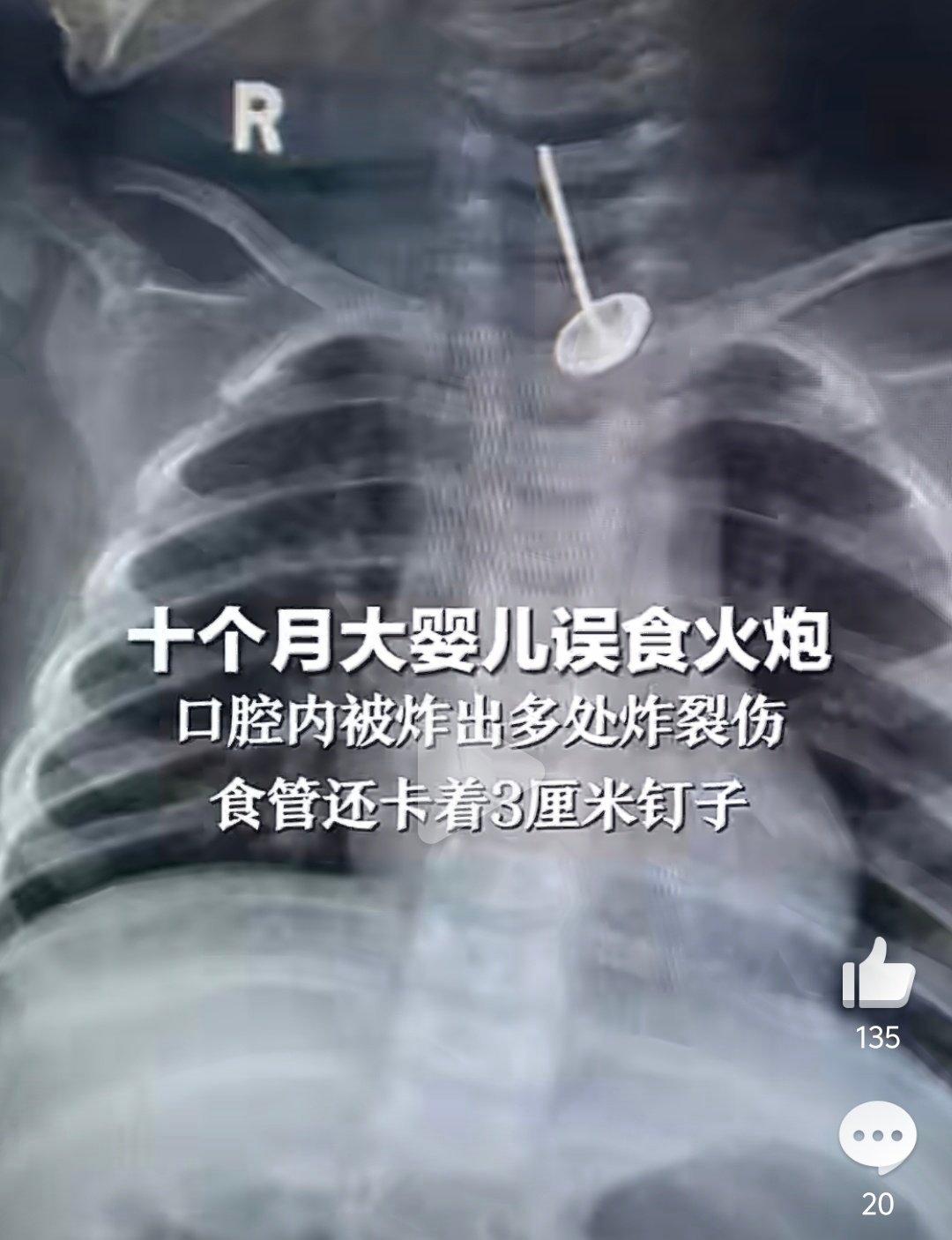 10月大婴儿误食鞭炮口腔炸伤小东西还是放在孩子够不到的地方孩子喉咙里面卡着3cm