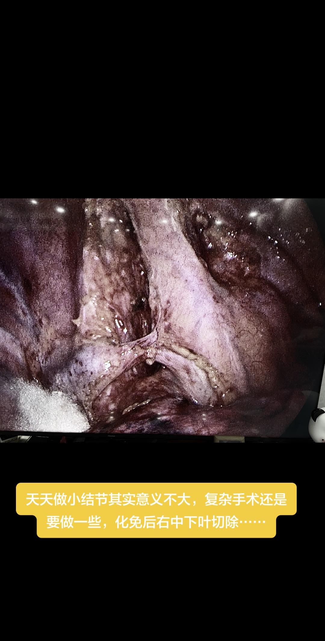 医学科普 肺癌 健康知识科普