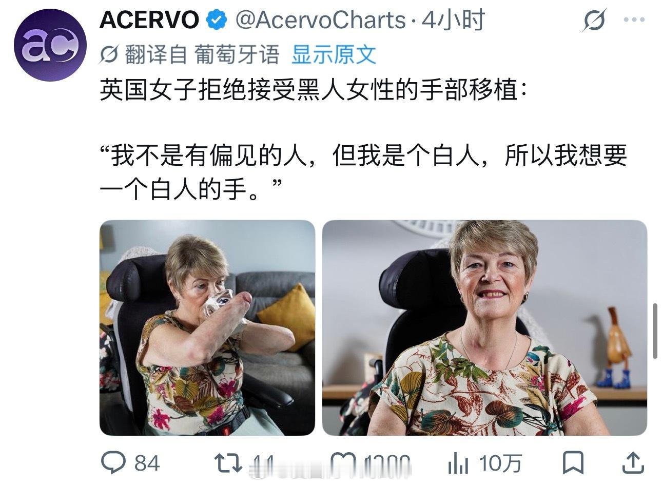 一个英国白人女子因拒绝接受黑人手部的移植，她外国网友被认为有严重的种族歧视。。。