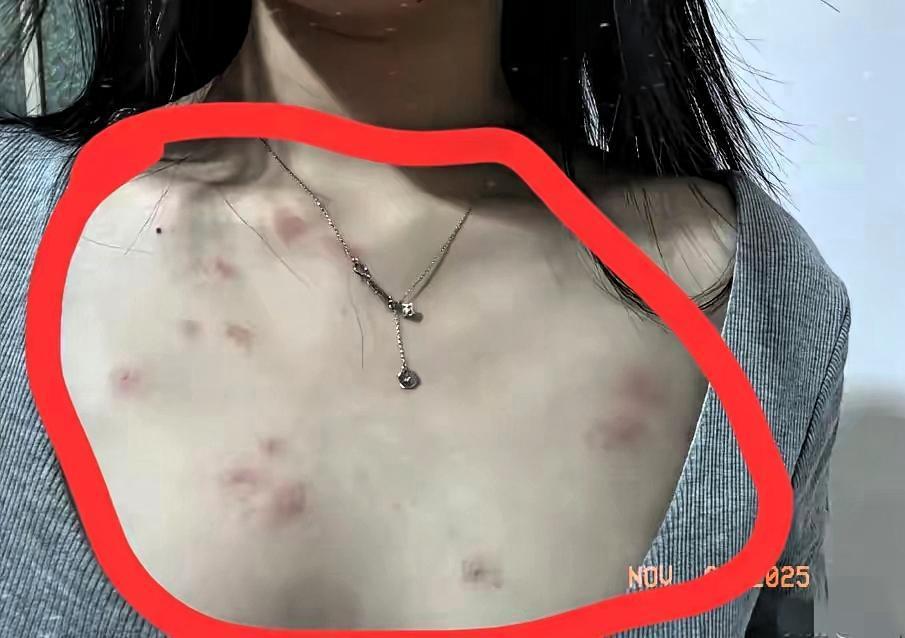 这个是来自一个女粉丝的投稿，她好像也是被感染到了。很大的可能是她男朋友传染给他的