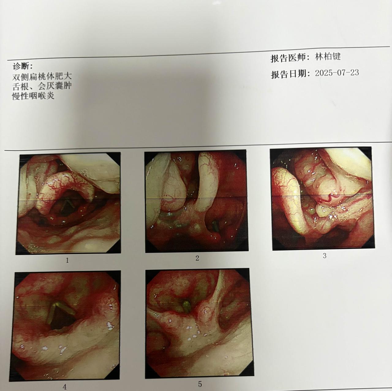 说好的是会厌囊肿，结果手术又变成淋巴滤泡，本来切囊肿和扁桃体的，结果囊肿变成了淋