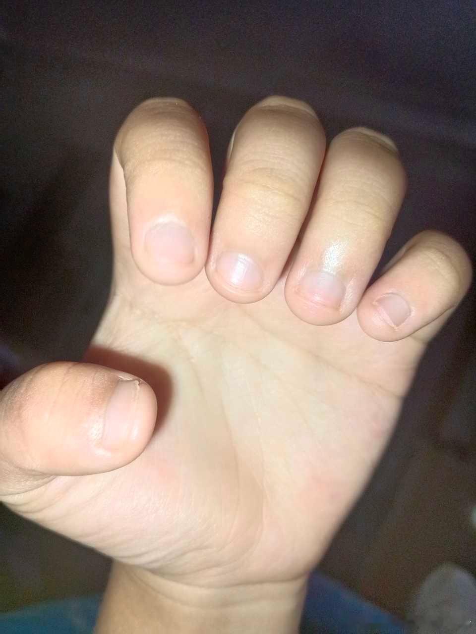 【💅🏻37768】高柱从小就喜欢咬指甲咬到现在一直改不掉，大拇指还是D型甲，