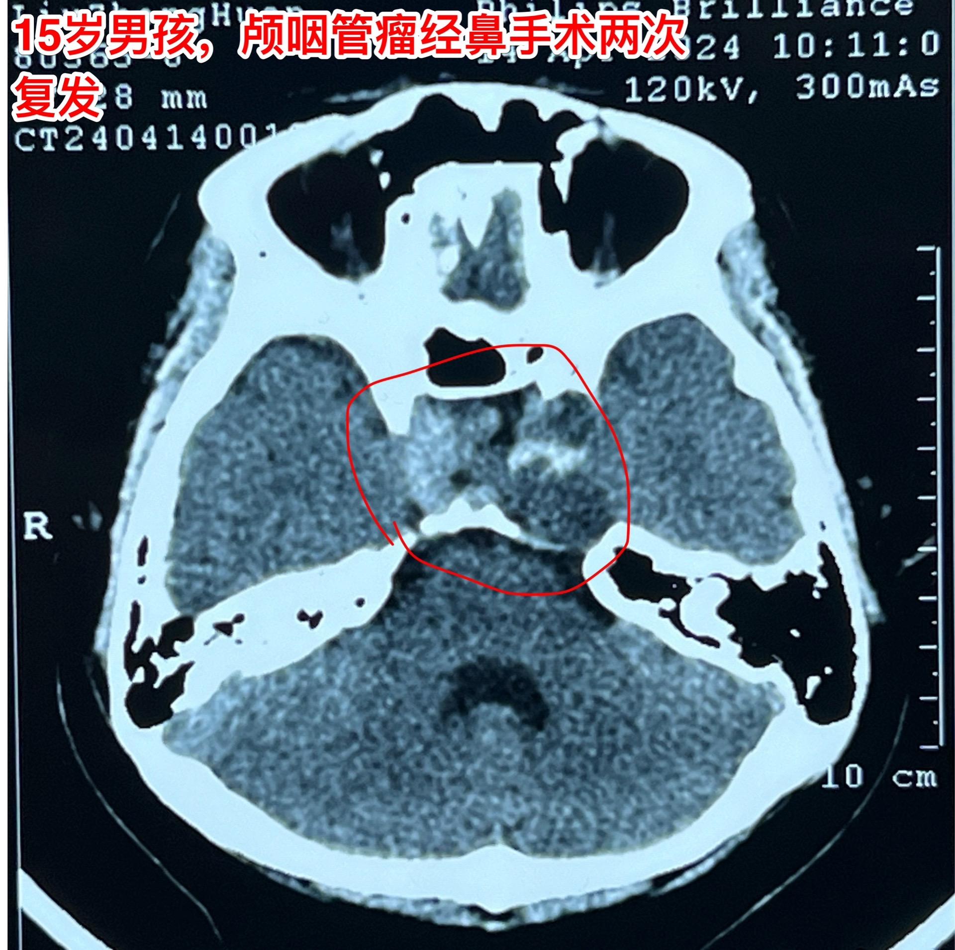 良性肿瘤也不一定容易治愈，颅咽管瘤就是。这个15岁大连市的男孩子因为颅咽管瘤先后作了两次手术，两次手术都是经鼻内镜手术。现在又复发了！从图片可以看见，这次肿瘤侵入左右两侧海绵窦，更难切除了。
         在我科作了第三次手术，这次采用开颅手术。这样的手术医生很担忧出现脑脊液鼻漏的。这个病人手术后没有出现脑脊液鼻漏。
         颅咽管瘤之所以容易复发是因为没有被彻底切除，如果彻底切除了也是可以治愈的。