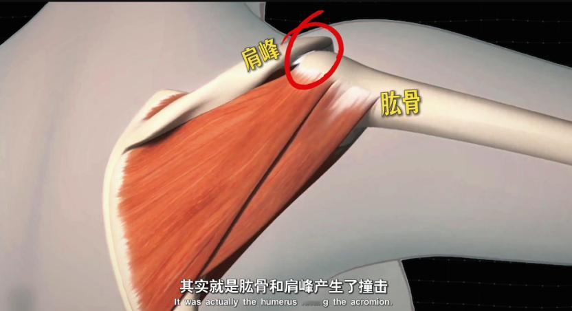 一抬胳膊，或者进行上肢健身运动时，肩关节开始弹响和疼痛，而且你怎么活动肩膀都不太