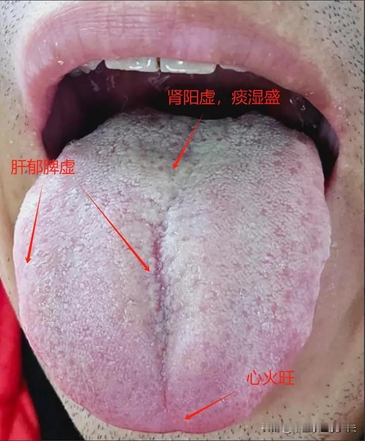 舌根苔白腻如积雪，若你就认为是阳虚，去补阳，越补越虚！方向搞错，吃啥都炉头不对马
