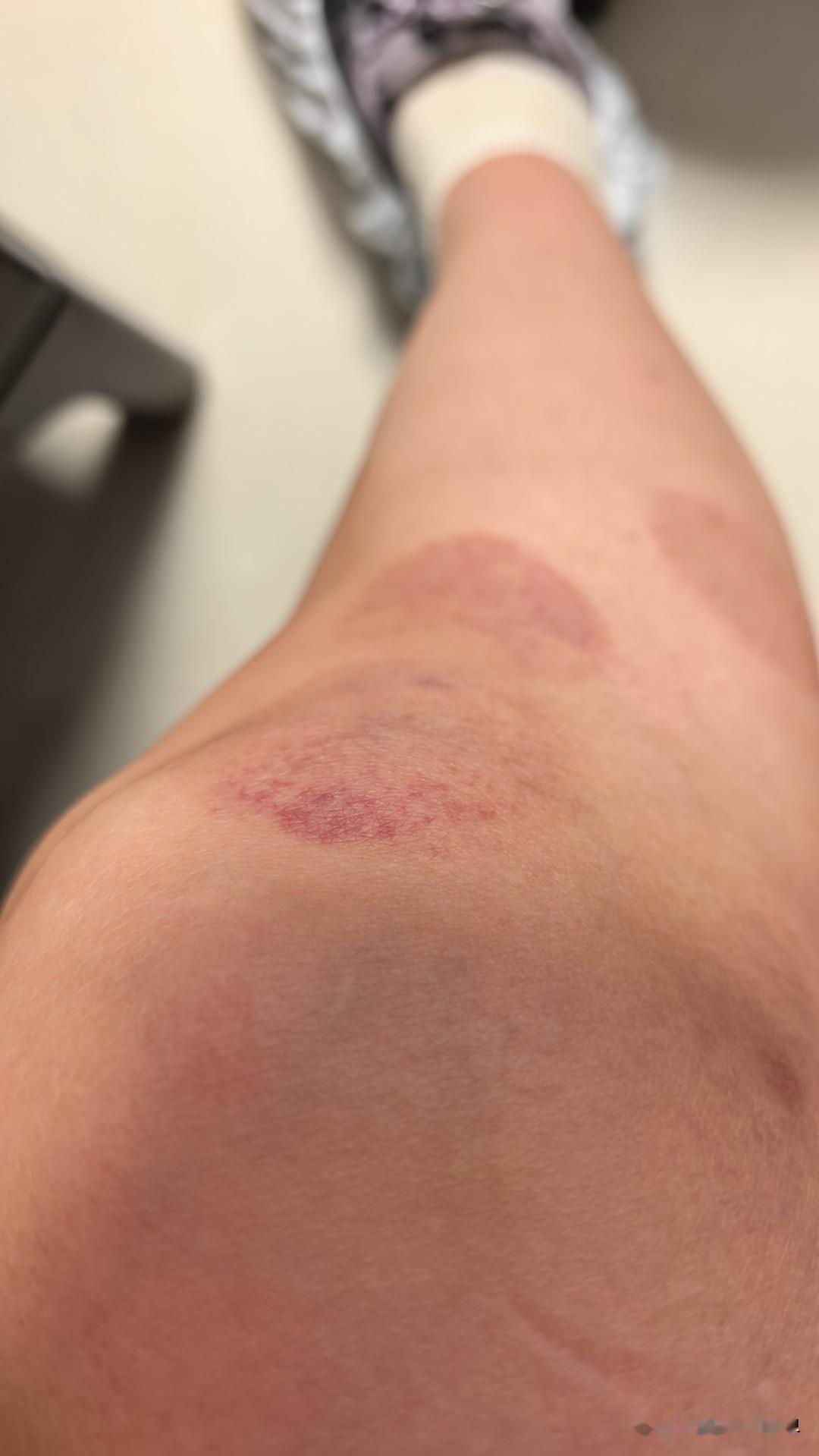 可谁能想到，扎完针之后，这膝盖疼没减轻，女中医让我隔天又去说有一个厉害的老中医要