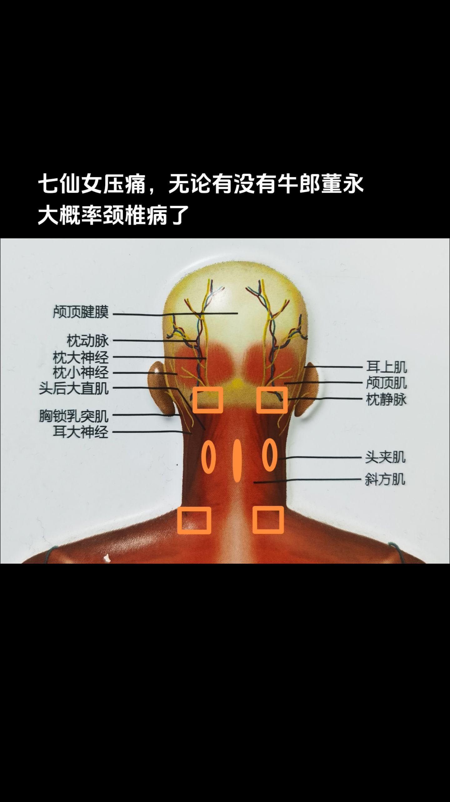 七点压痛，再伴有上肢麻木放射痛、头晕头痛脑胀啥的，更没跑了