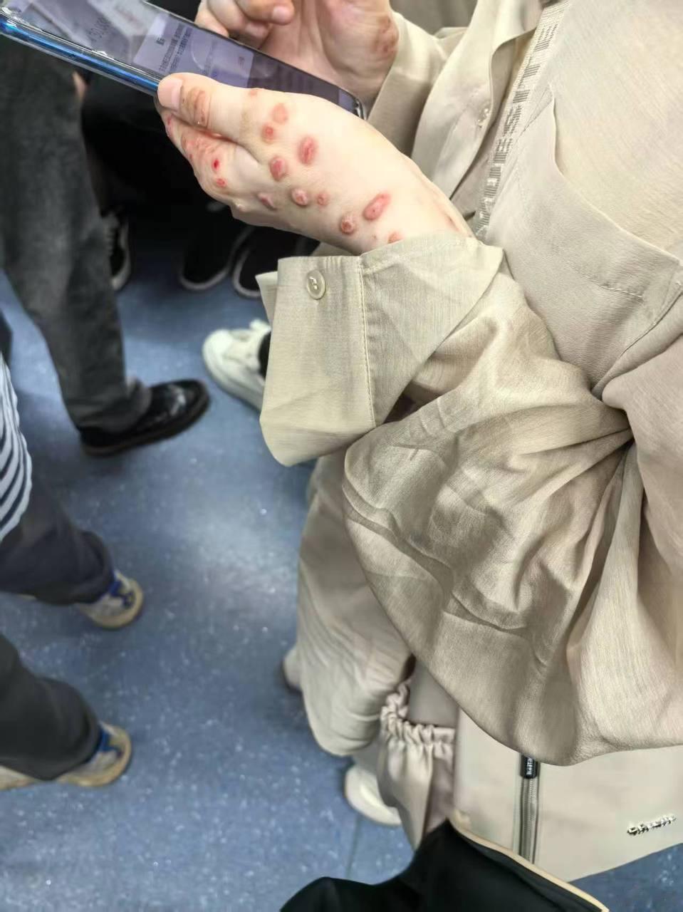 女朋友说午休时被蚊子叮了，好心疼！擦什么药会好的快呢？  ​​​