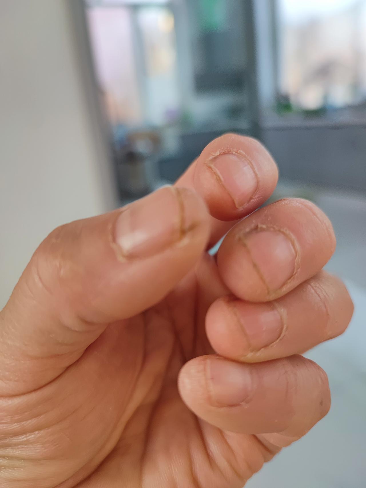 看看这双手，
能知道是干啥活的手吗？
粗刺沟裂，
还总在手指头两边裂口子。
这是