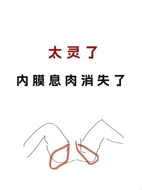 说了800遍了❗内膜息肉并非在于息肉本身❗