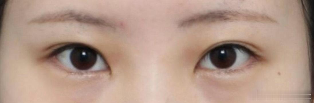 短圆眼做外眼角下至确实改善都挺大的 
