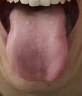 房事乏力的辨证思路：脾虚肝郁兼胃热，舌裂气虚，气血供给不足







有位粉