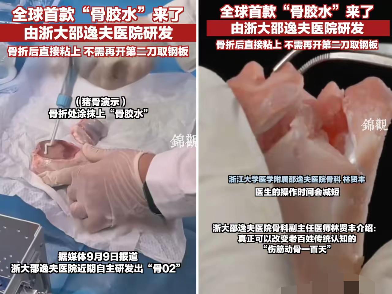 家人们，这次浙江邵逸夫医院又干出大事儿了！研发出全球首款骨胶水——“骨02”，直