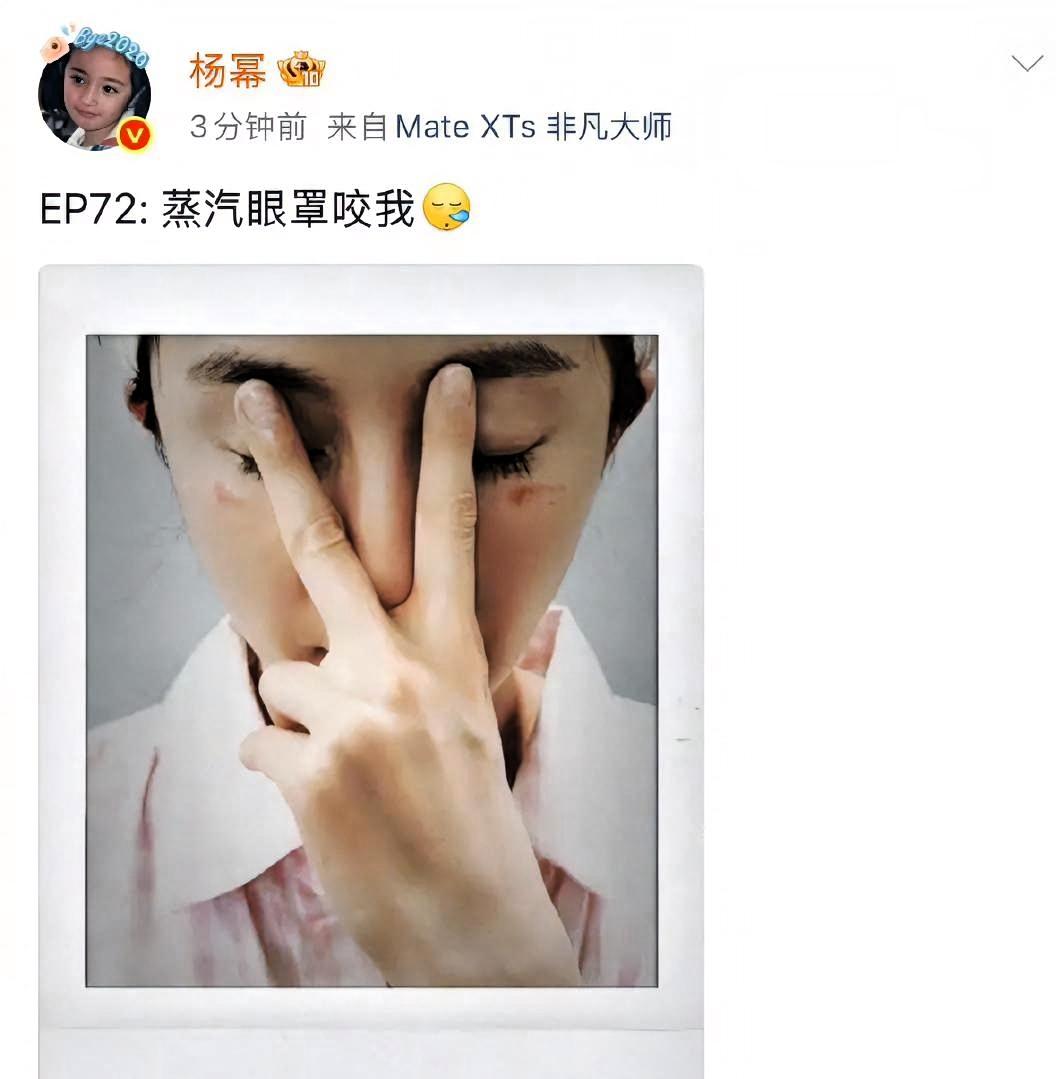 杨幂被蒸汽眼罩烫伤，脸上留下明显红印。她发微博说：“蒸汽眼罩咬我”。

评论区都