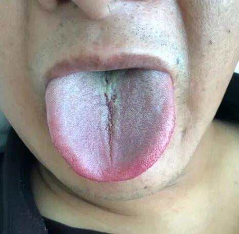 裂纹舌、脾胃虚弱：慢性胃炎患者如何改善？
在昨天的评论区，一位患者的情况引起了广