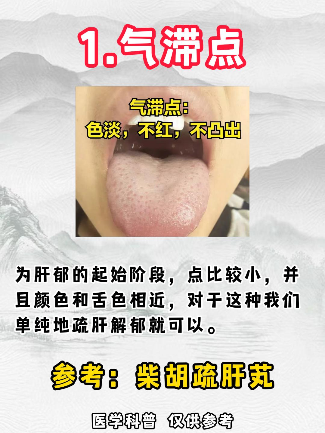 肝郁的人，从舌上气滞点就能看出肝郁程度，一个阶段一种用药！#涨知识##健康##科
