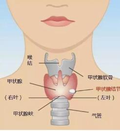 无论男女，出现甲状腺结节，记住1多2少，结节可能慢慢消失

当甲状腺这个位于咽喉