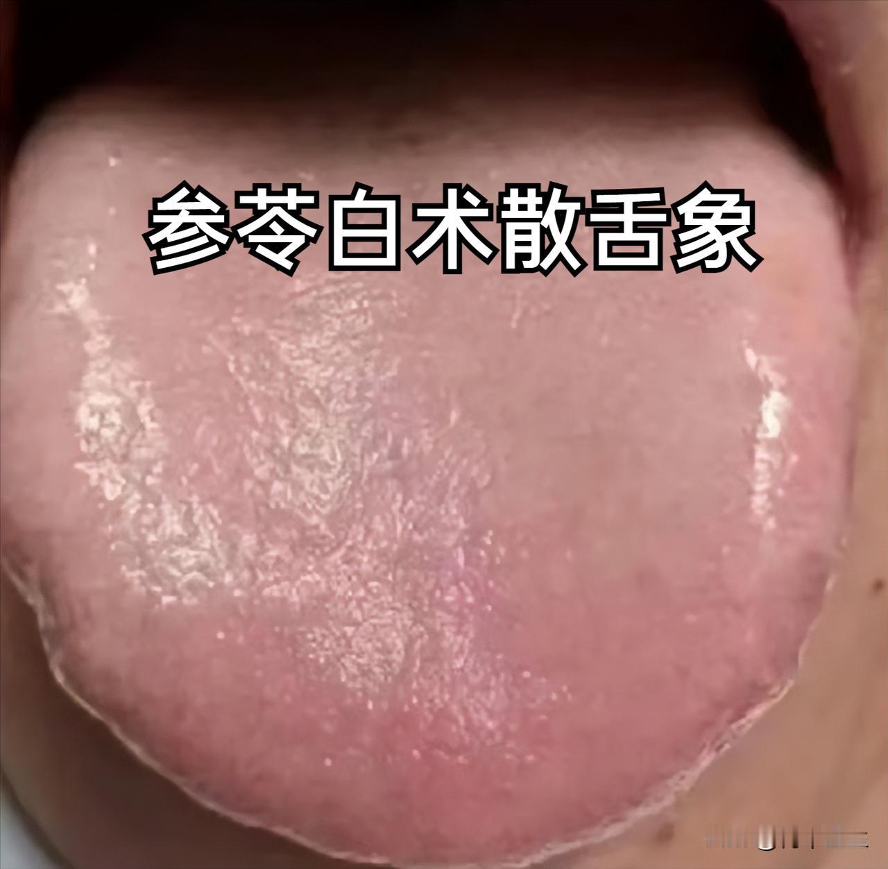 五个超猛祛湿经典方子，把全身的湿气吸干净，身体无湿一身轻

1. 脾虚有湿——参