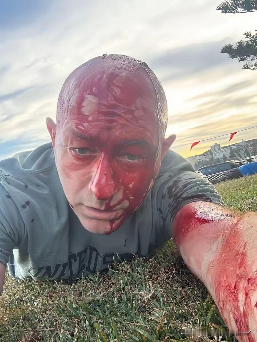 这次悉尼邦迪海滩发生的恐怖袭击不同一般，看看犹太社区领袖阿森・奥斯特罗夫斯基满脸