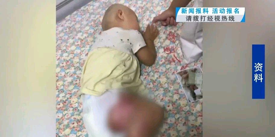 内蒙古女孩园园太让人心疼了。七个月大时，她不慎掉进开水锅，全身30%皮肤严重烫伤