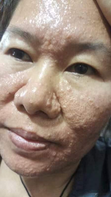 此证俗名鬼饭疙瘩，由汗出受风，或露卧乘凉，风邪多中表虚之人，初起皮肤作痒，次发扁