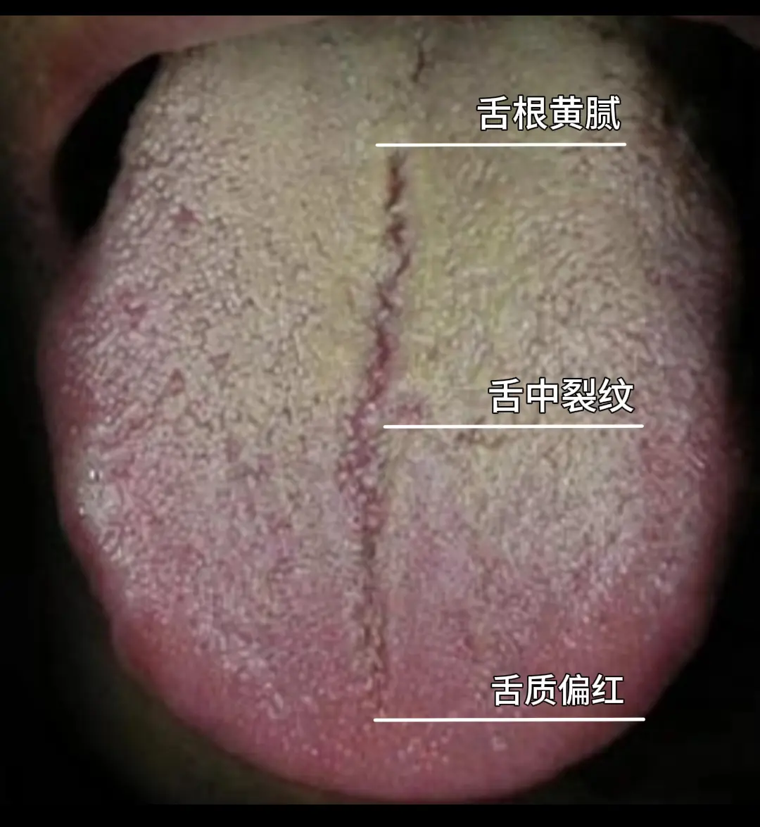 湿热不可怕，最怕的是阴虚夹湿热，该滋阴还是该祛湿！！！  患者主诉：尿...