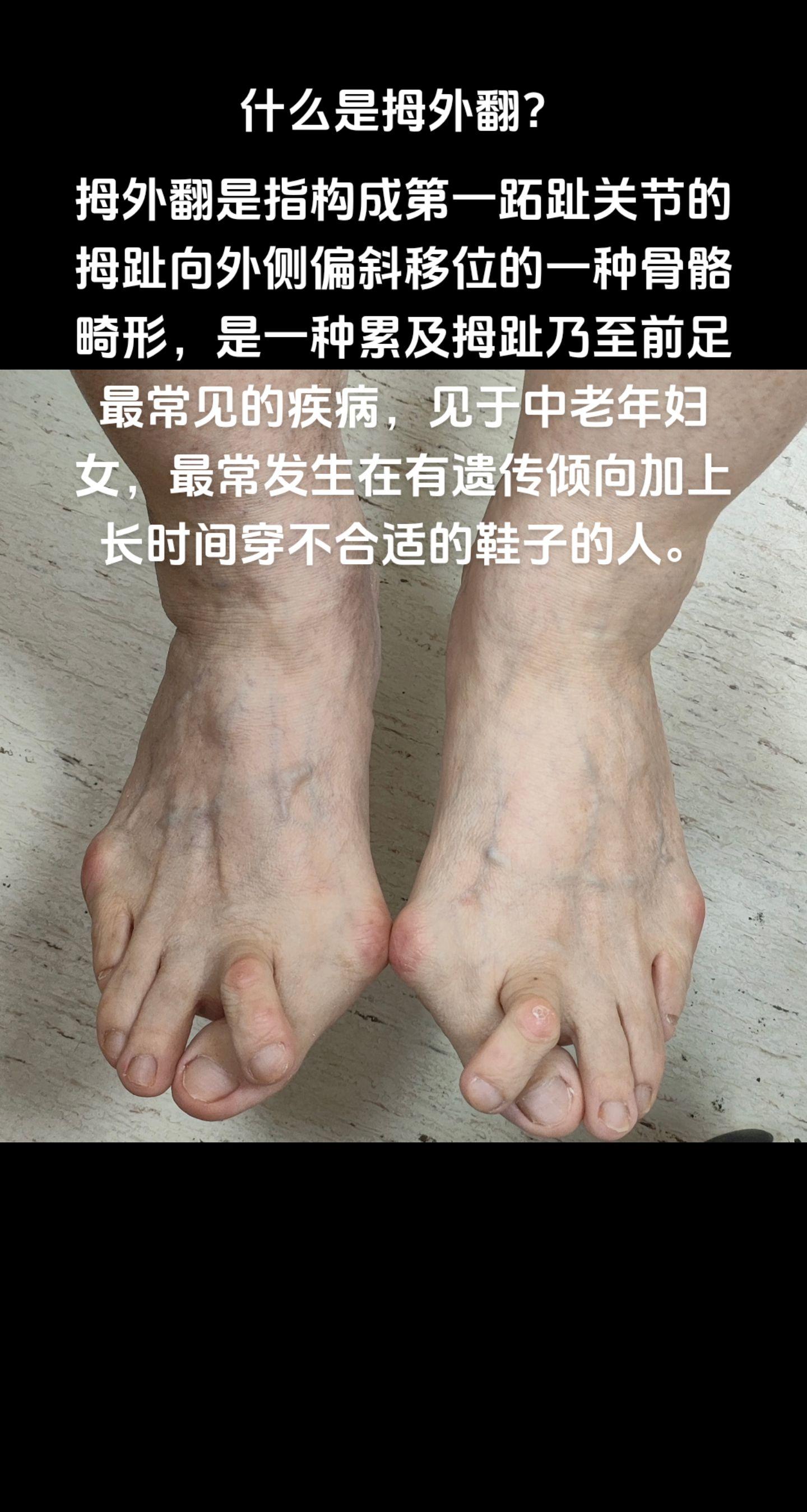 什么是拇外翻？足痛
