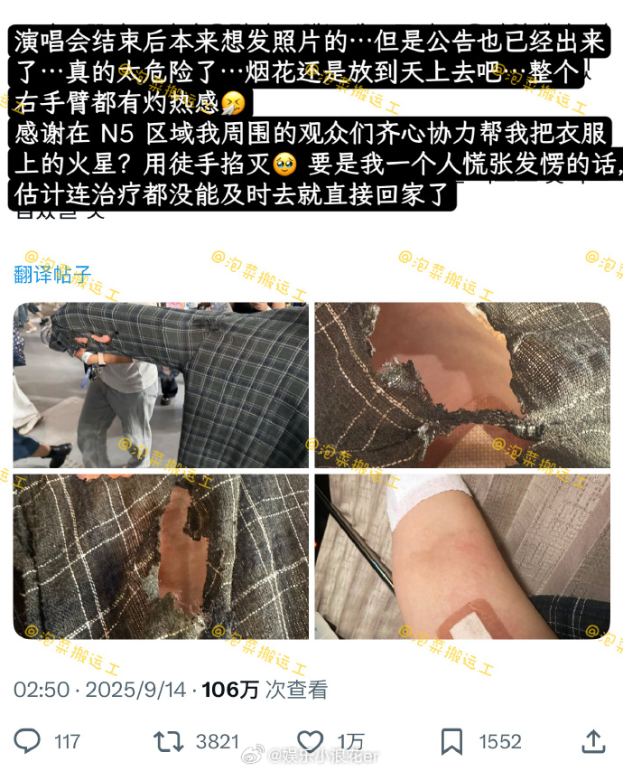 粉丝被seventeen演唱会烟花溅到受伤 天哪，看着好痛！ ​​​