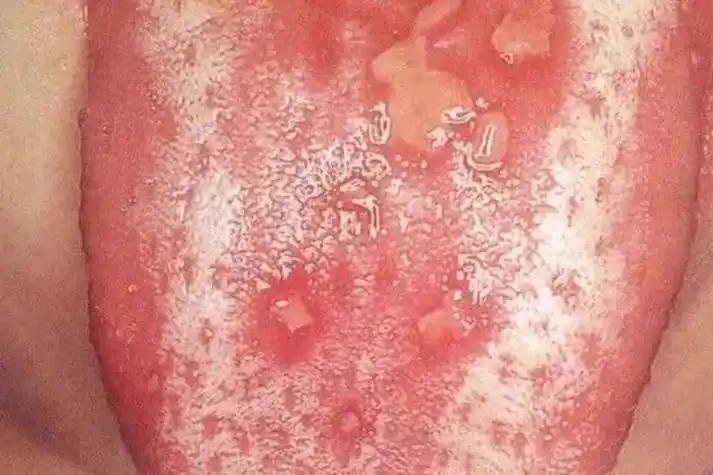舌头上长泡，就是溃疡了？医生提醒：或是3种疾病在作怪，大意不得！



“医生，