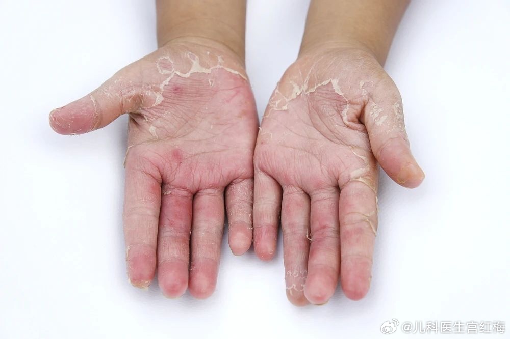 孩子手脚莫名脱皮、掉皮，不痛不痒，看着吓人。不是缺维生素！也不是皮肤病！夏季绝大
