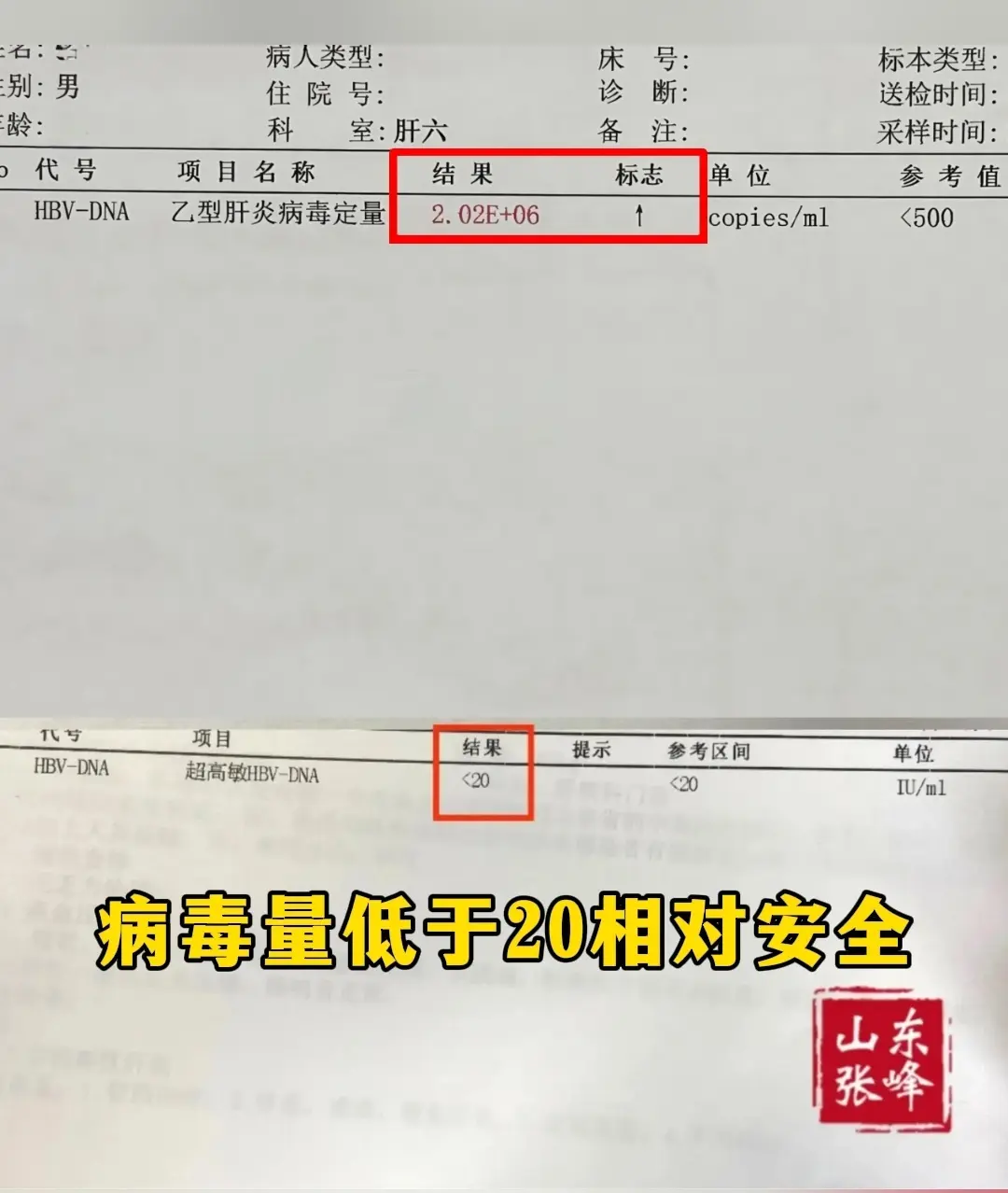 山东菏泽的一位乙肝患者到院复查，一开始病毒量2.02E+06，高病毒载...