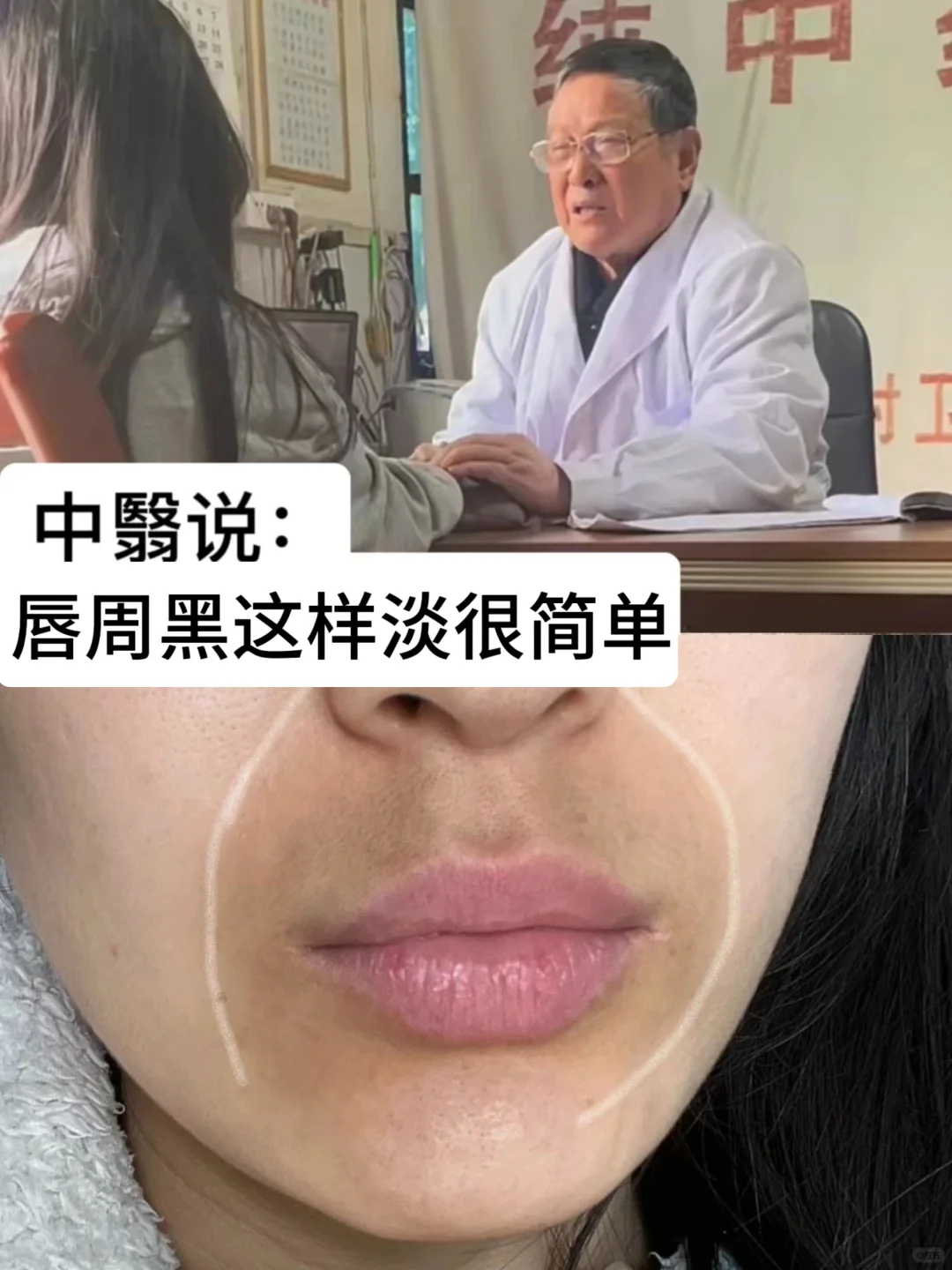 不删！重度唇周黑姐妹不看真的淡不了！
