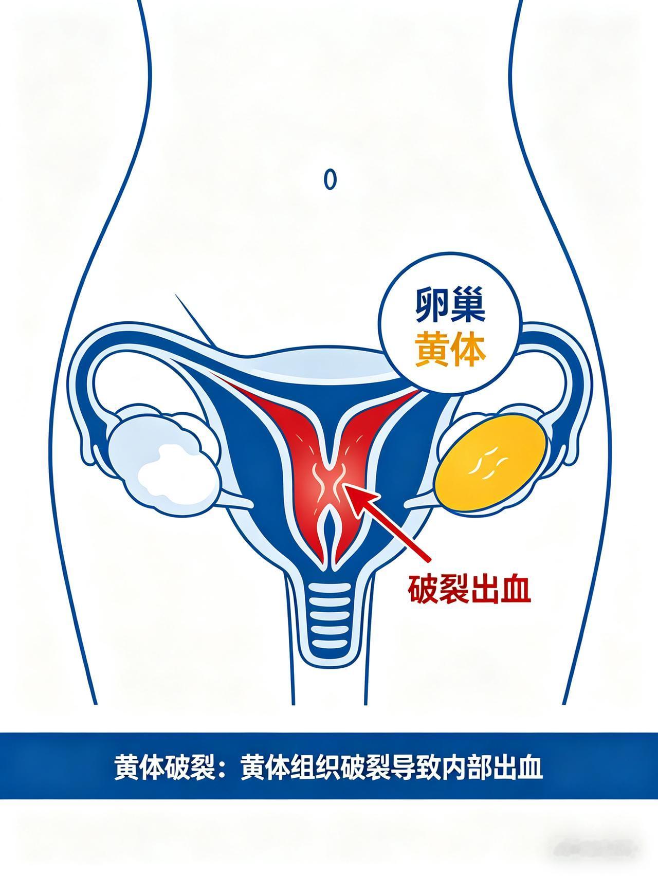 女子同房后腹痛硬扛，差点丢了命。
 
安徽一名三十岁的女子，同房后没多久下腹部就