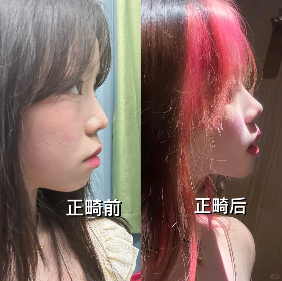 补牙5颗 拔牙4颗 整牙进程终于过半！