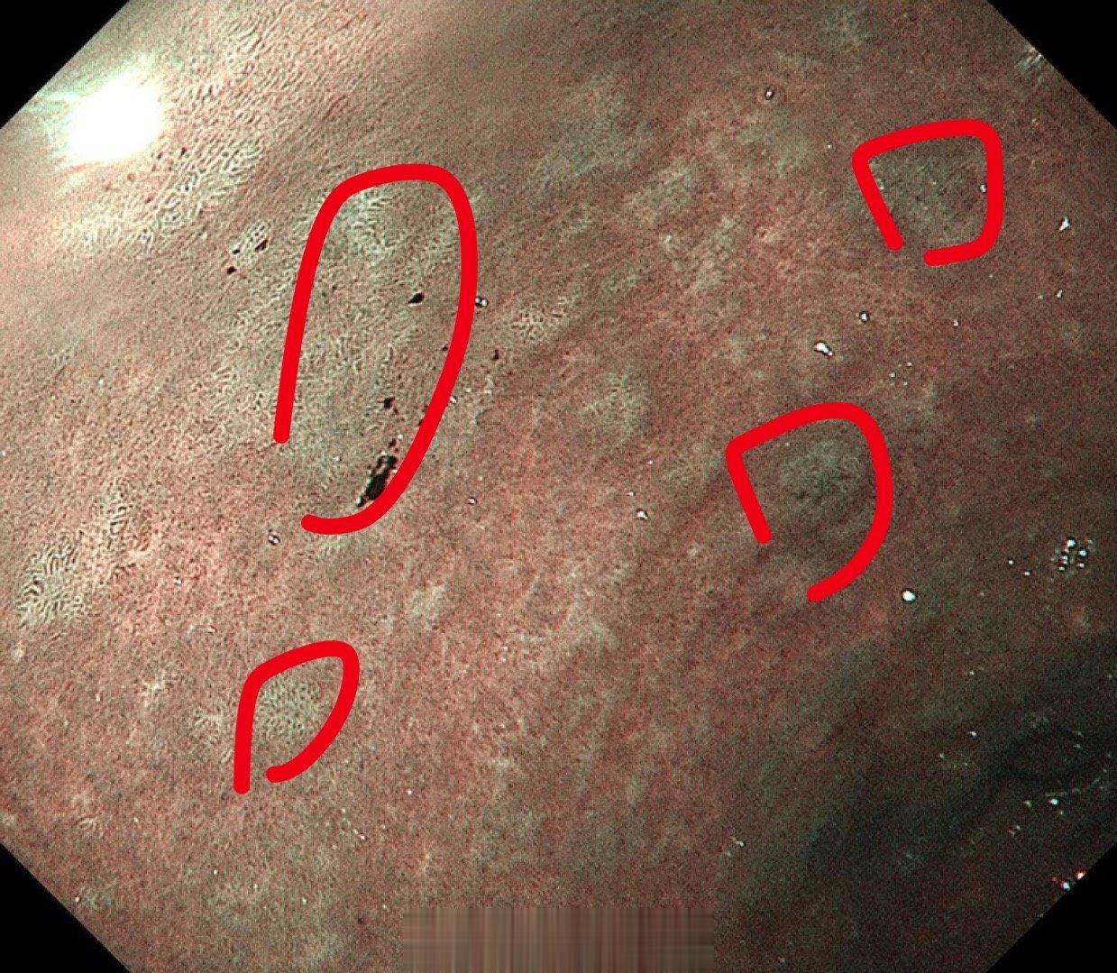 在线经常有问诊对活检的结果看得很重，其实我们筛查早癌的时候对这个活检结果并不是特