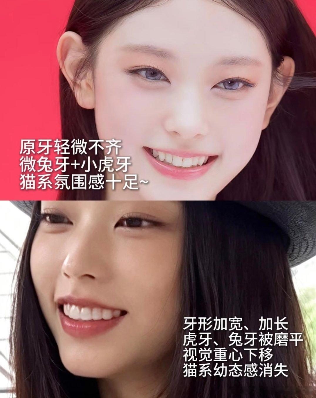 牙贴面技术很难吗，韩娱爱豆基本上都做失败了 
