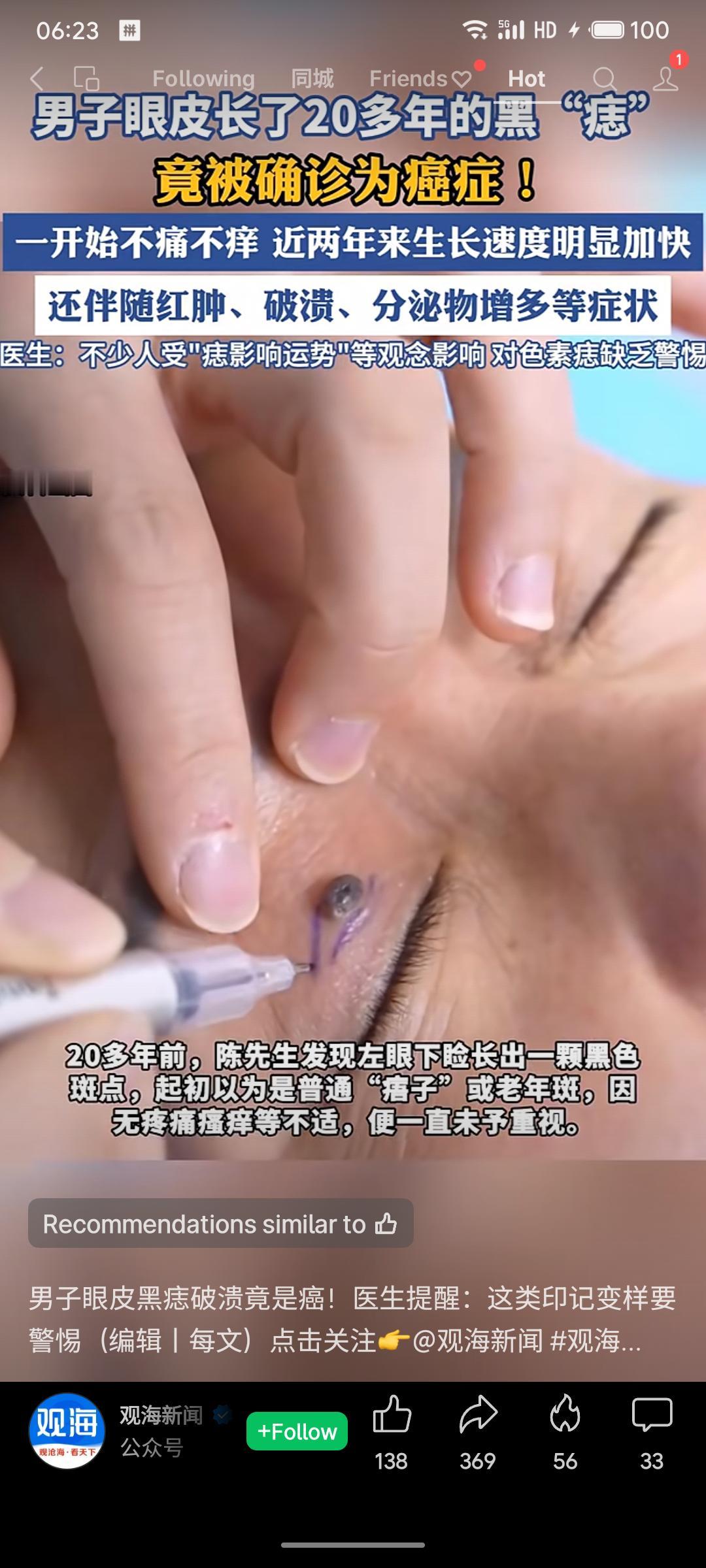 一名男子左眼下睑的黑