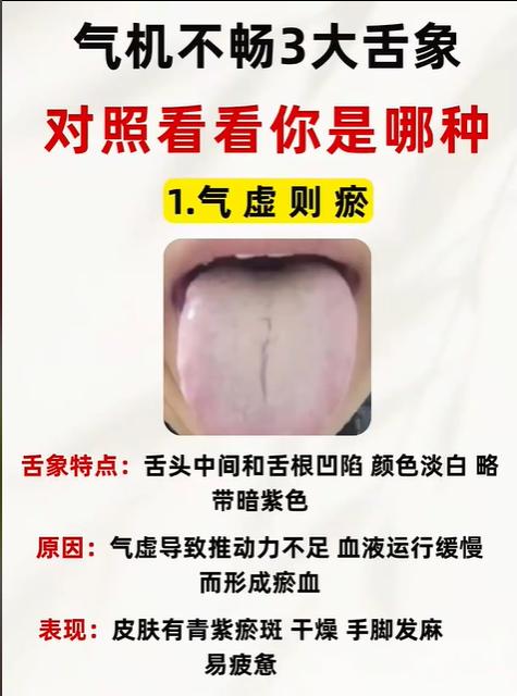 舌诊分析：气机不畅的3大舌象，对照看看你是哪一种