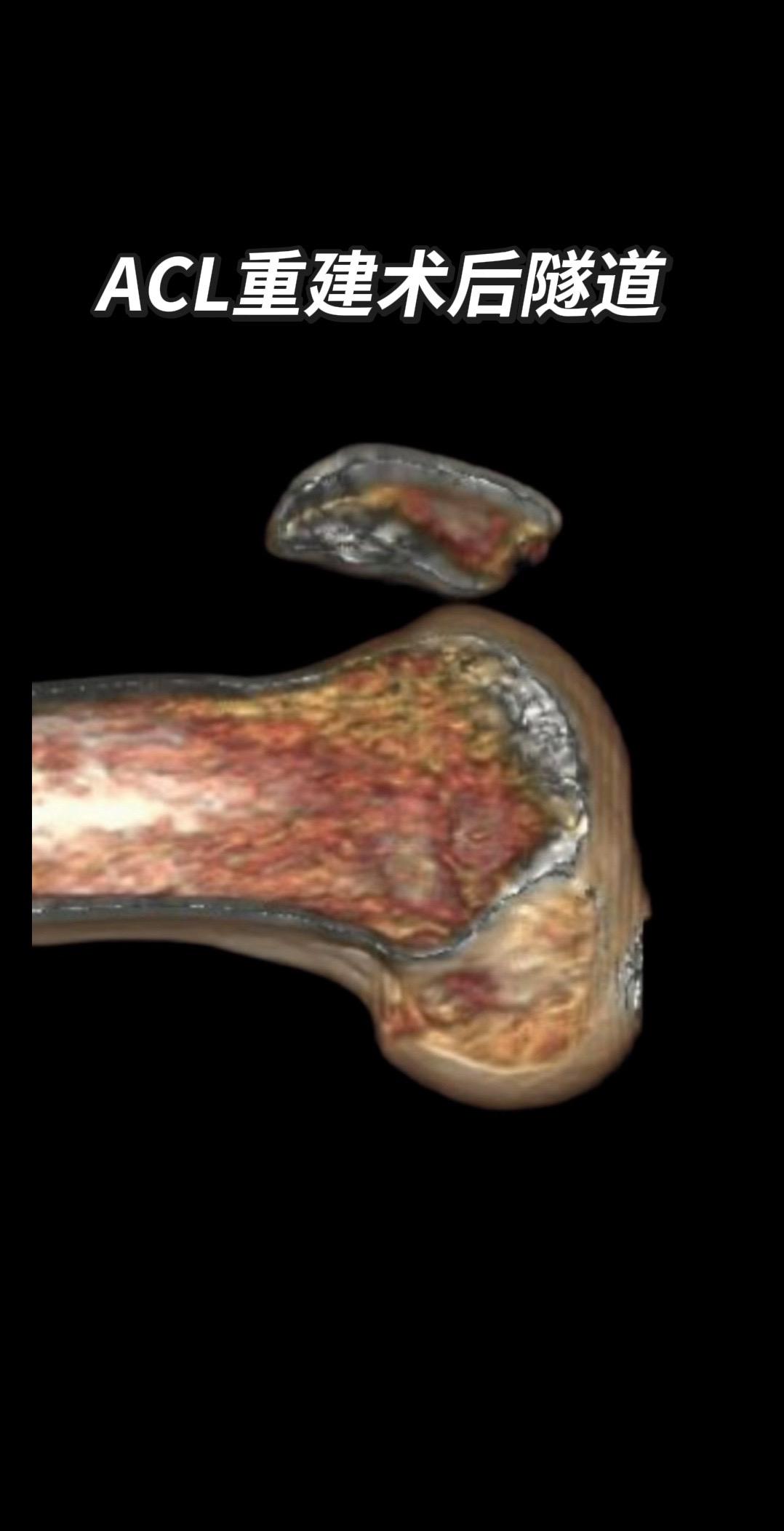 ACL重建术后隧道。