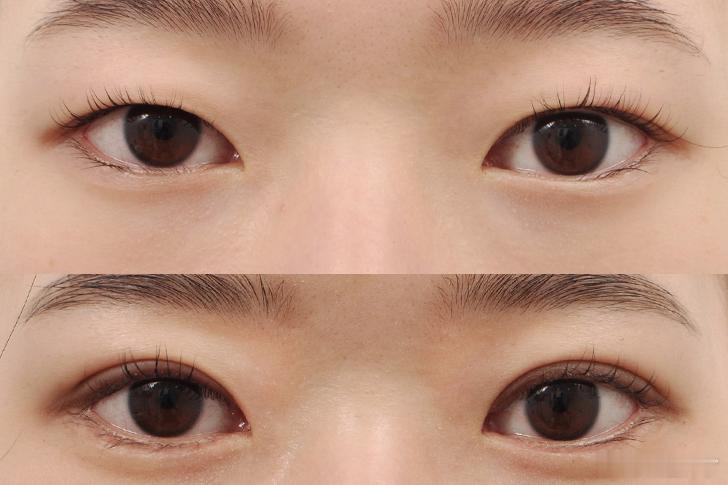 韩国自然黏连（也就是埋线）+去皮+提肌 