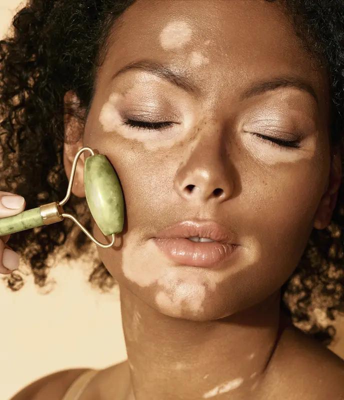 面部得了白癜风应该怎么护理呢?