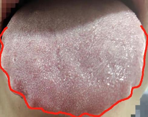 舌胖大 + 暗紫苔厚腻？这是寒湿裹着瘀血，关节冷痛就因它！
大家好，我是中医陈大